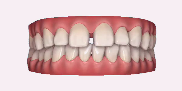 Gapped Teeth